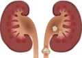 سنگ کلیه چه علائمی دارد؟ سنگ کلیه چه علائمی دارد؟