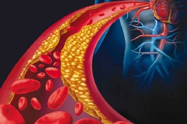ژن درمانی کلسترول بد را ۵۰ درصد کاهش داد ژن درمانی کلسترول بد را ۵۰ درصد کاهش داد